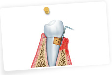 根本的に歯周病を改善する歯周内科治療